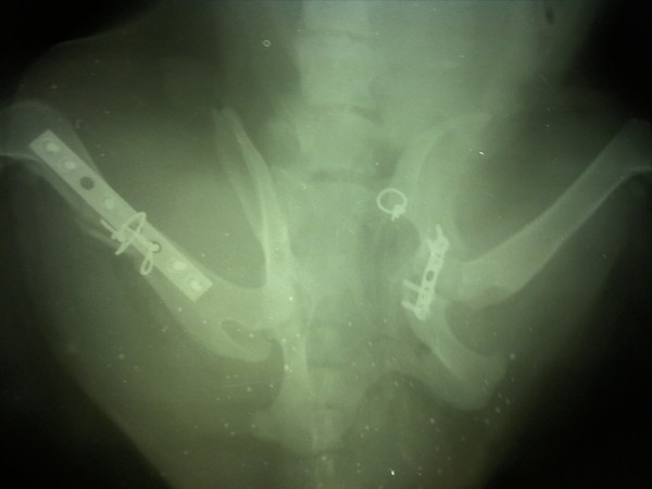 множественный перелом таза и бедра после операции
